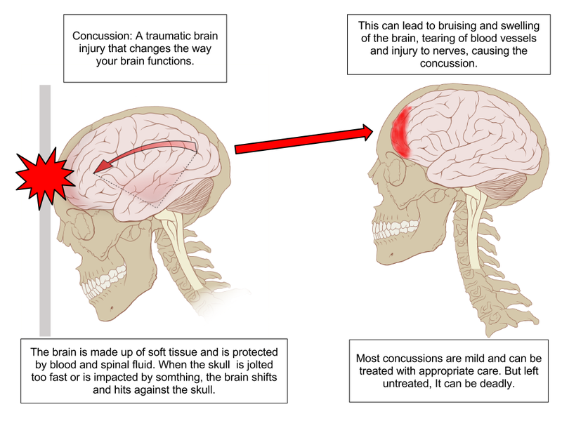 800px-Concussion_Anatomy